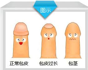 男人什么样是包皮过长？什么样又是包茎呢？