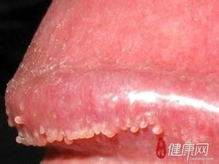 男性尖锐湿疣能治好？【尖锐湿疣吃这几种食物***】