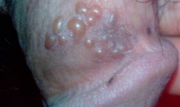 包皮里面总是有水泡是什么情况？【因为你做了这几件事】