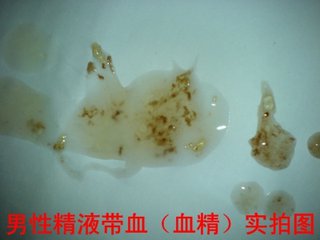 男性射精带血怎么回事？该怎么办