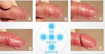 龟头正常是什么样（图）哪些疾病会导致龟头不正常？