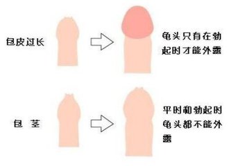 【包茎手术流程图片】包茎手术全过程详细介绍