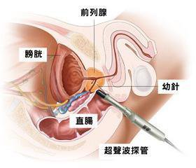 （图）【男生前列腺在哪】四个方法找准前列腺位置并检查