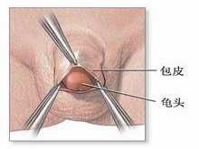 【孩子包皮过长什么症状】包皮过长的不良影响有哪些？