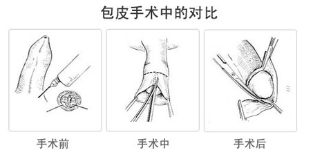 【包皮手术后水肿不消】包皮手术后有肿块怎么回事？