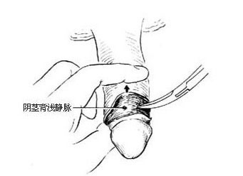 包皮手术流程