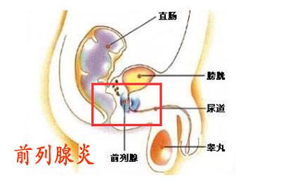 前列腺炎疼痛难忍怎么办？前列腺疼痛难忍表现在哪里？