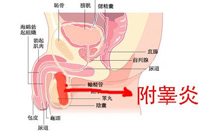 【症状】睾丸附睾炎如何治疗？睾丸附睾炎2个症状