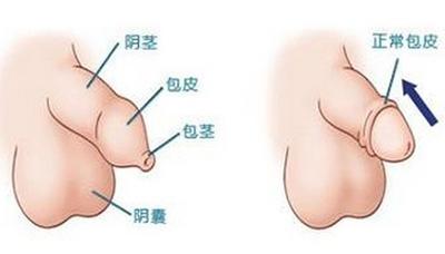 【图解】什么是包皮过长？包皮过长会造成哪些危害？