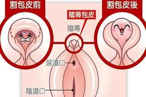 包皮过长会影响怀孕吗？医生解答