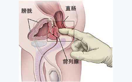 慢性前列腺炎小便发黄吗？3个因素造成小便发黄