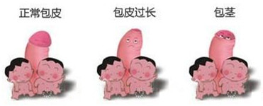 小孩子包皮过长会影响发育吗?小孩子包皮过长怎么办?