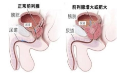 前列腺多大为肥大？前列腺肥大有什么危害？