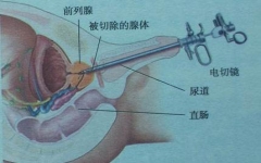 得了前列腺肥大怎样治疗？「治愈案例分享」