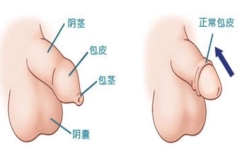 包茎割前割后图，真实对比让你目了然！