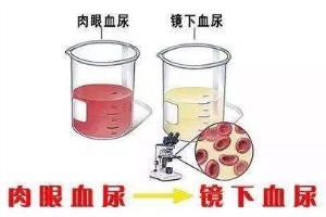 血尿***发作是么原因？可以吃止血药吗？