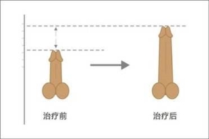 阴茎延长手术***吗？这三点***少不了